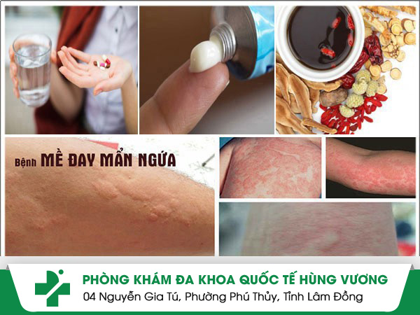 Tạm biệt mề đay nhờ đúng thầy đúng thuốc