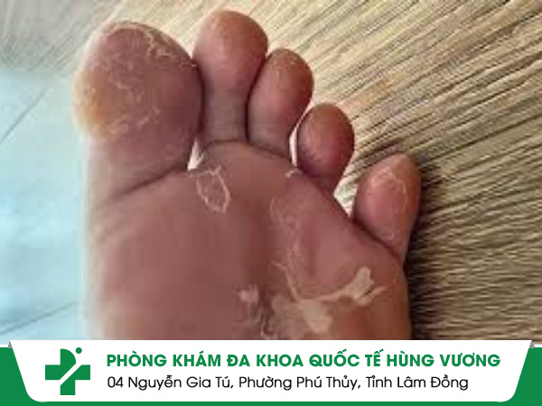 Tay Chân Bị Lột Da – Đừng Chủ Quan Với Những Dấu Hiệu Nhỏ!