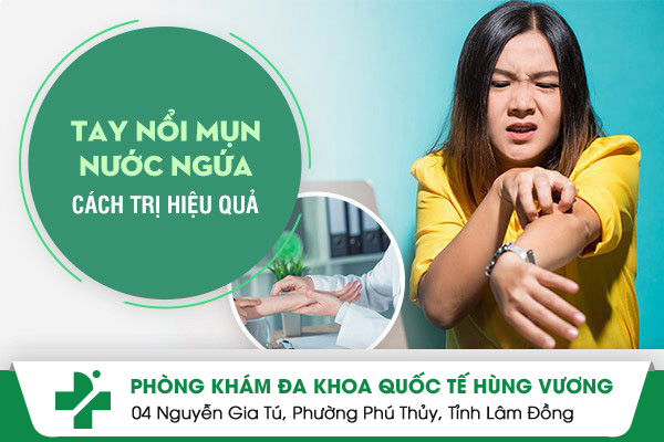 Tay Nổi Mụn Nước Ngứa - Cách Điều Trị Hiệu Quả