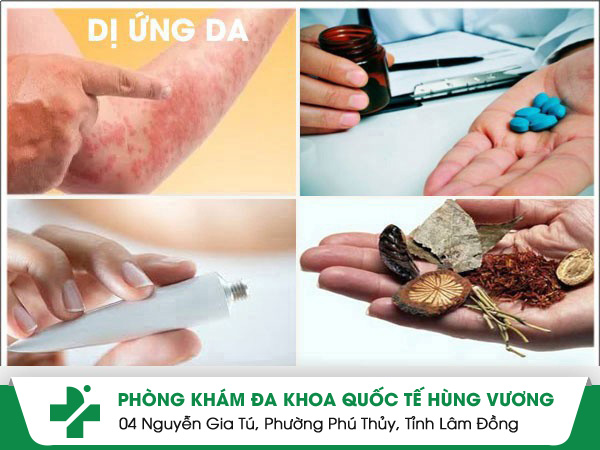 Thuốc chữa dị ứng và cách lưu ý khi sử dụng