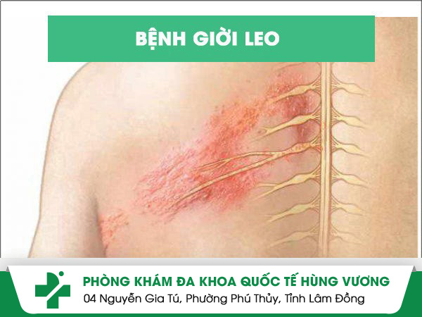 Thuốc chữa giời leo chỉ trong một liệu trình