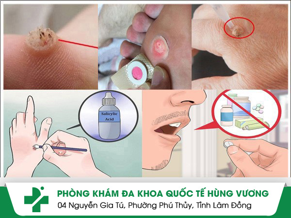 Mụn Cóc – Đừng Chủ Quan Với Những Tổn Thương Nhỏ Trên Da