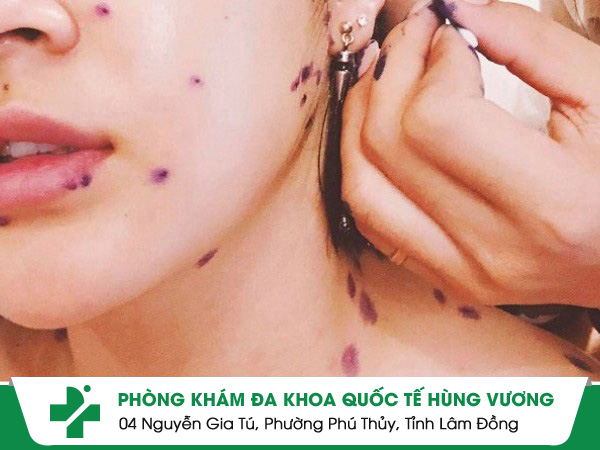 Bệnh Thủy Đậu: Đừng Chủ Quan – Biến Chứng Có Thể Gây Tử Vong!