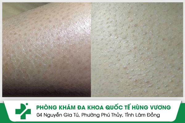 Dày Sừng Nang Lông: Lỡ Xem Thường – Mang Theo Nỗi Tự Ti Cả Đời