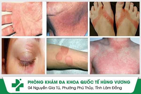 Các bệnh dị ứng da thường gặp hiện nay. thuốc trị dị ứng