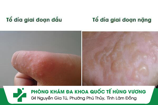 Bệnh Tổ Đỉa Lây Lan Nhanh Nếu Không Kiểm Soát Đúng Cách – Đừng Bỏ Qua!