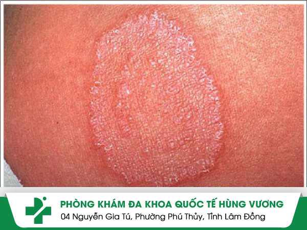 Tổng quan về bệnh nấm mà bệnh nhân cần hết sức chú ý