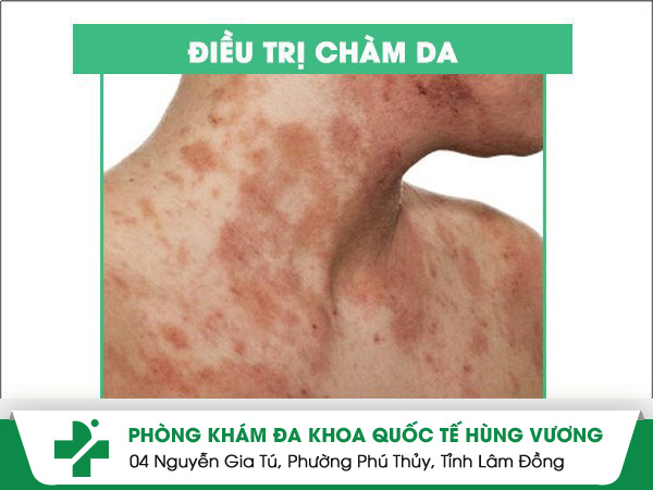 Điều trị chàm da bằng phương pháp hiện đại