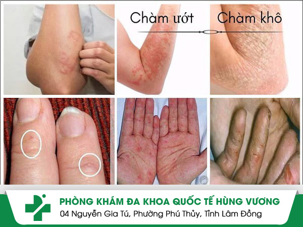 Trị chàm tay hiệu quả nhanh bằng liệu pháp đơn giản