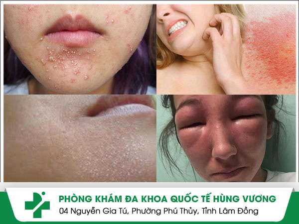 dị ứng da mặt
