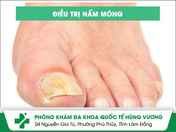 Điều trị nấm móng hiệu quả nhanh chóng an toàn
