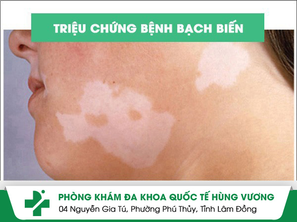 Bạch Biến – Căn Bệnh Khiến Làn Da “Biến Mất Màu”