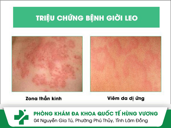 Triệu chứng bệnh giời leo mà nhiều người hay gặp phải