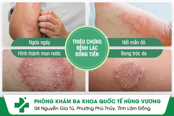 Triệu chứng bệnh Lác đồng tiền và cách điều trị hiệu quả