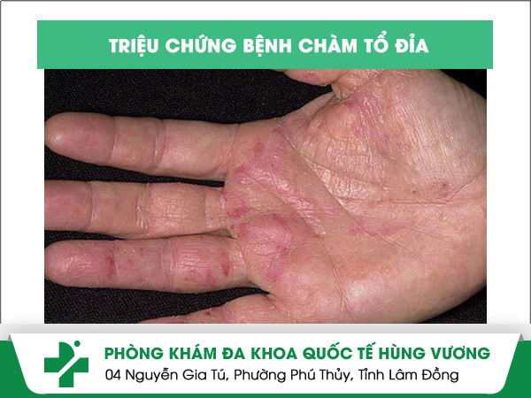 Làm thế nào để nhận biết bệnh chàm tổ đỉa tay chân?