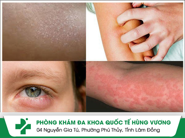 Triệu chứng dị ứng da bệnh nhân cần hết sức chú ý