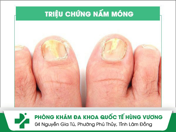 Triệu chứng nấm móng: cảnh báo nguy cơ da liễu ở nhiều người