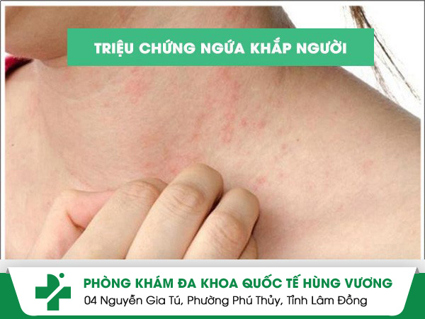 Triệu chứng ngứa khắp người là bị bệnh gì?