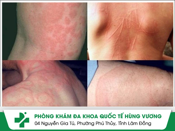 Triệu chứng nổi mề đay dễ nhận biết bệnh nhân không nên bỏ qua