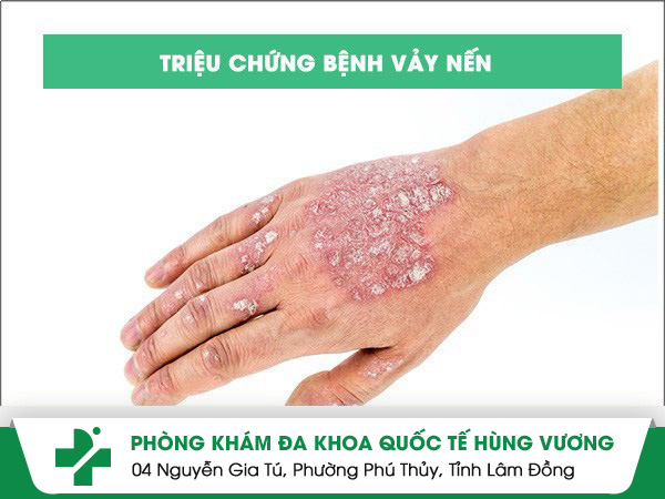 Triệu chứng bệnh vảy nến sớm nhận biết và điều trị kịp thời