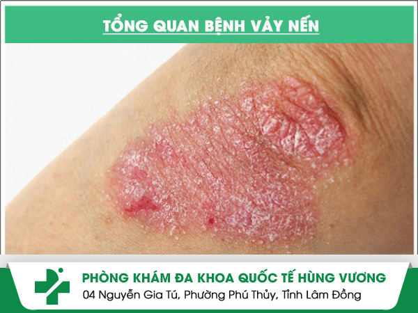 Tổng quan về bệnh vảy nến và cách điều trị