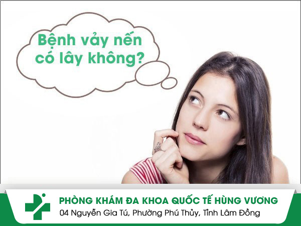 Vảy nến có lây không? Làm thế nào điều trị bệnh vảy nến?
