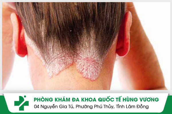 Tất tần tật thông tin về vảy nến da đầu bạn nên biết