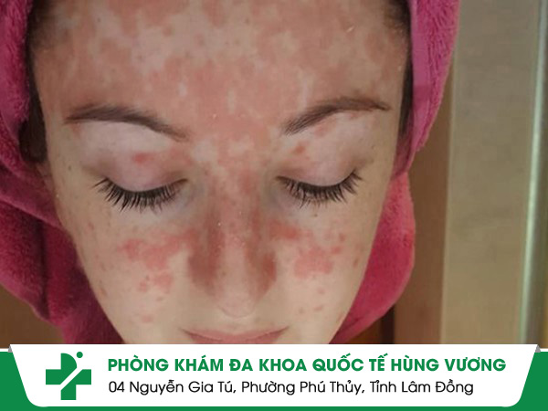 vảy nến da mặt