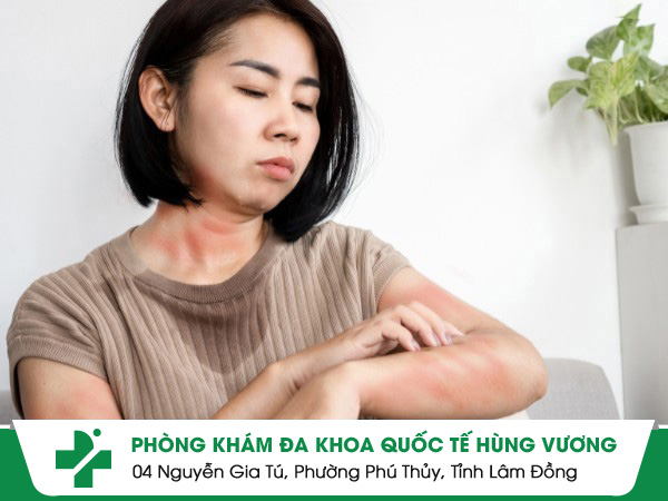 Những điều cần biết về bệnh vảy nến toàn thân