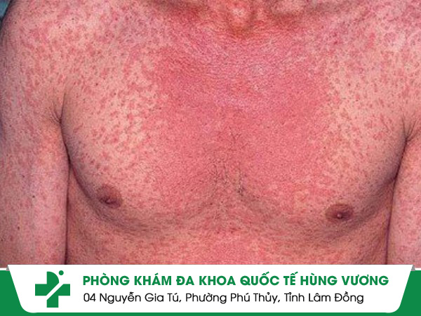 Hình ảnh bệnh vảy nến toàn thân. vảy nến toàn thân