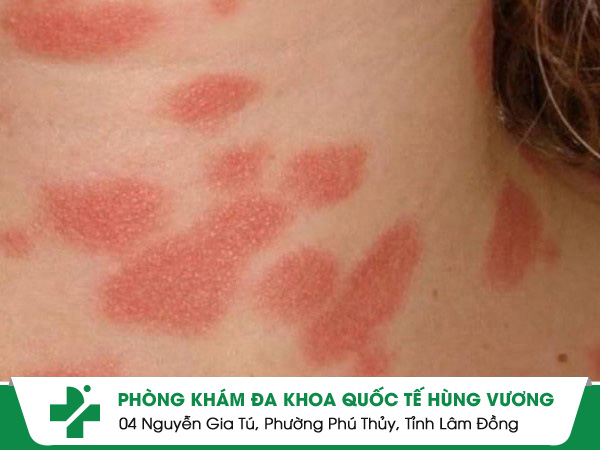 Những điều cần biết khi điều trị bệnh vảy phấn hồng