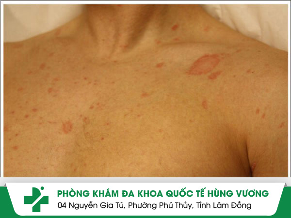 Sự thật đằng sau bệnh vảy phấn hồng và cách điều trị đáng kinh ngạc