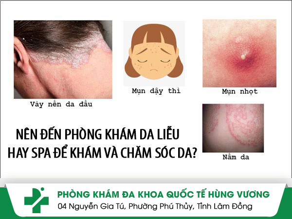 90% bệnh nhân lựa chọn khám và chăm sóc da ở phòng khám da liễu thay vì đến Spa