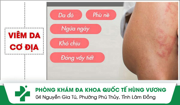 Biến chứng của viêm da cơ địa