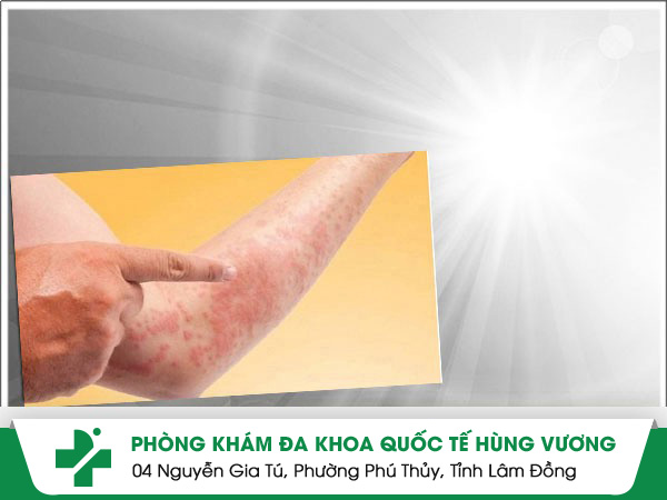 Viêm da tiếp xúc do ánh nắng - triệu chứng và cách điều trị