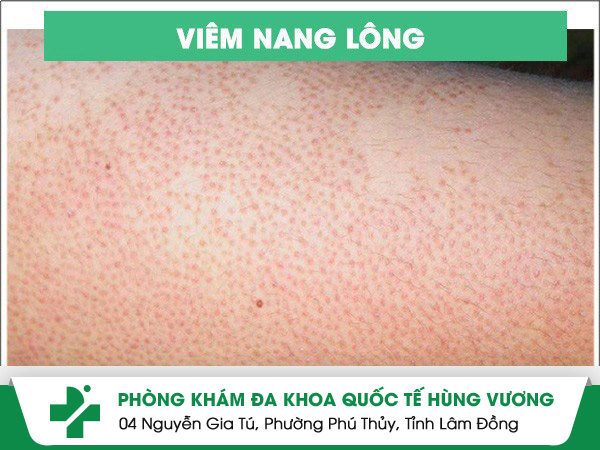 Viêm nang lông nguyên nhân và cách điều trị