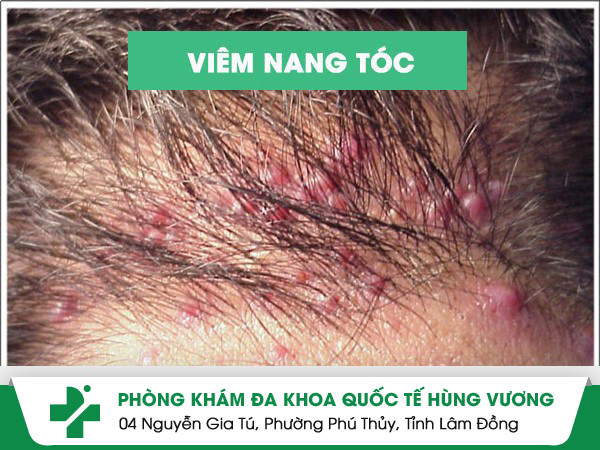 Viêm nang tóc nguyên nhân và cách điều trị