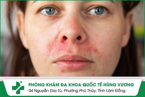 Cẩn Thận Với Bệnh Viêm Da Nhờn