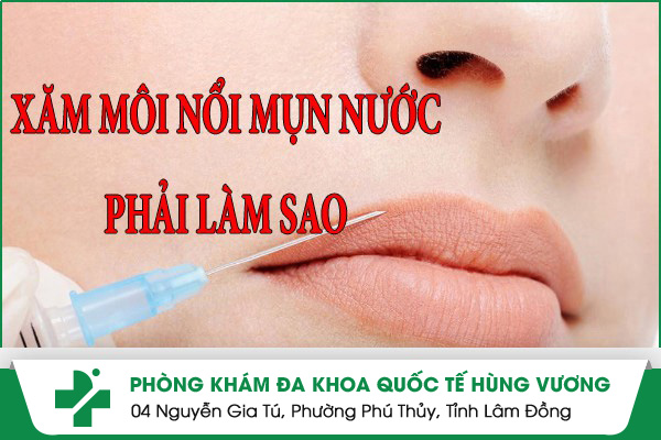 Xăm Môi Bị Nổi Mụn Nước Phải Làm Sao?