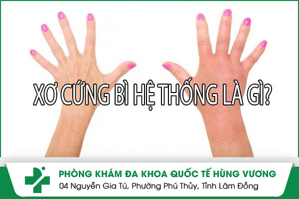Bệnh Xơ Cứng Bì Hệ Thống Là Gì?