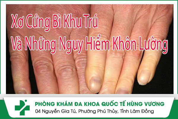 Xơ Cứng Bì Khu Trú Và Những Nguy Hiểm Khôn Lường
