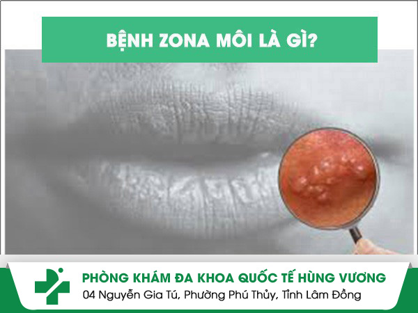 Những điều cần biết về bệnh zona môi
