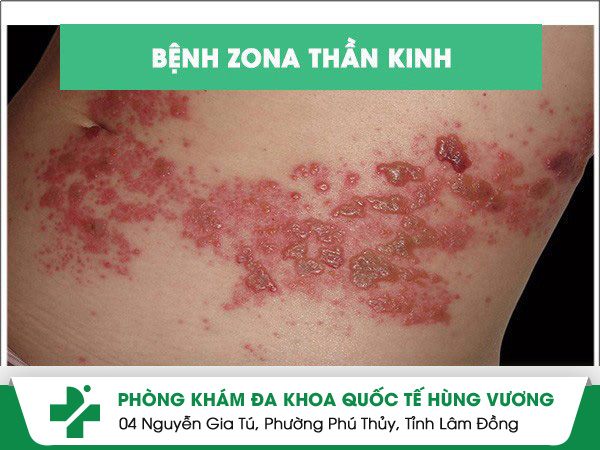Bệnh zona thần kinh nguyên nhân và cách điều trị